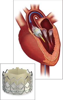 TAVR